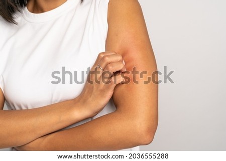 Close up of woman scratching itch on hand, suffer from dry skin or pruritus isolated on studio grey background. Animal food cosmetic allergy, dermatitis, insect bites, irritation concept.  Royalty-Free Stock Photo #2036555288