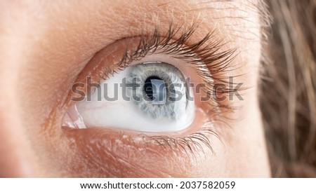woman eye with corneal dystrophy, keratoconus, thinning of the cornea. Royalty-Free Stock Photo #2037582059