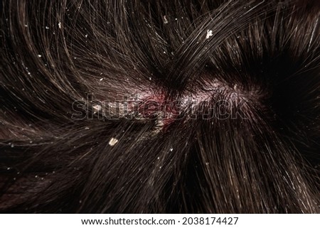 Dandruff on the hair. Hair disease seborrhea. Royalty-Free Stock Photo #2038174427