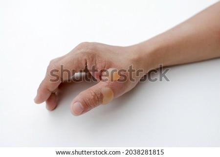 Patient's hand and thumb with heat blisters and injuries. Blister wound care in hospital with white background.Skin wounds.Patient with serious burns.First and second degree burn.Emergency care. Royalty-Free Stock Photo #2038281815