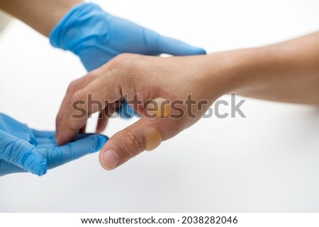 Patient's hand and thumb with heat blister and injuries. Blisters on body parts.Wound care in hospital white table.Skin wounds.Patient with serious burns.First and second degree burn.Emergency care. Royalty-Free Stock Photo #2038282046