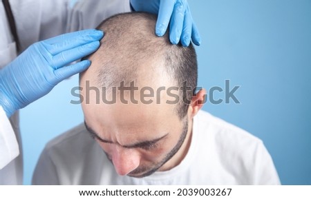 Doctor hands on patient head. Hair growth Royalty-Free Stock Photo #2039003267
