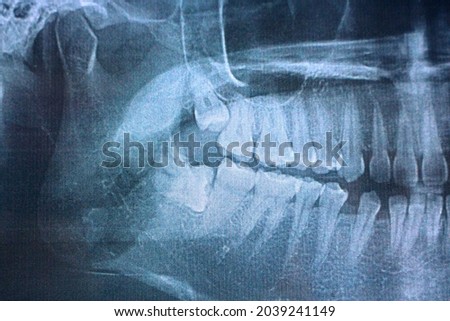 Panoramic radiograph of multiple tooth impaction in upper and lower side. Third molar tooth impaction.  Royalty-Free Stock Photo #2039241149