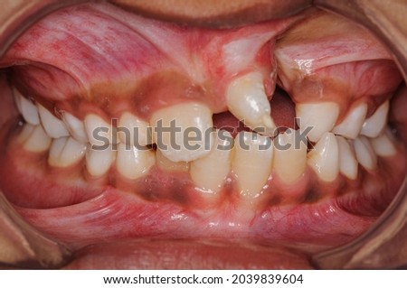 Intra-oral front retracted view of dentition of a child with unilateral cleft alveolus and palate. Royalty-Free Stock Photo #2039839604