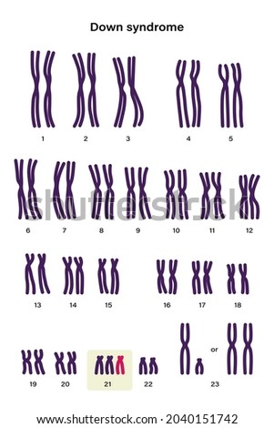 Human karyotype of Down syndrome. Autosomal abnormalities. Down syndrome have an extra copy of one of these chromosomes, chromosome 21. Trisomy 21. Genetic disorder  Royalty-Free Stock Photo #2040151742