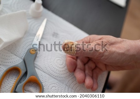 Felon whitlow on hand finger toe injured to lose nail treatment and removed nail Royalty-Free Stock Photo #2040306110