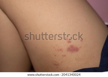 A red rash on the skin is scaly.