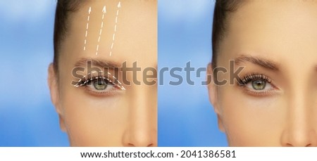 Lower and upper Blepharoplasty.Marking the face.Perforation lines on females face, plastic surgery concept. Royalty-Free Stock Photo #2041386581