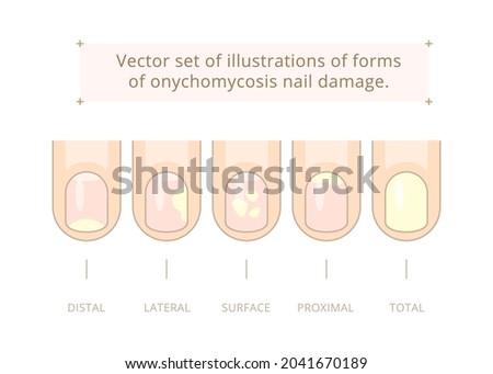 Vector set of illustrations of forms of onychomycosis nail damage. Distal, lateral, superficial, proximal and total forms