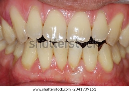 edge to edge bite occlusion. If  front teeth bite together exactly on their edges, then you have an edge-to-edge bite. Ideally, front teeth should close down over the front of  lower front teeth Royalty-Free Stock Photo #2041939151