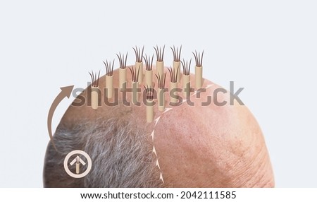 Methods of hair transplantation FUT and FUE fue with transplant as infographic element of illustration. Human alopecia or hair loss problem on adult senior or mature man. Before and after concept Royalty-Free Stock Photo #2042111585