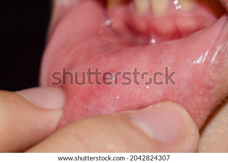 Small vesicle lesion at lower lip of Asian man. Royalty-Free Stock Photo #2042824307
