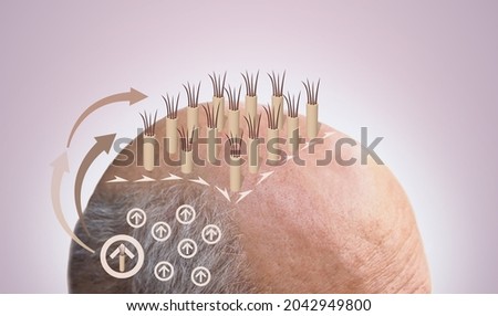 Methods of hair transplantation FUT and FUE fue with transplant as infographic element of illustration. Human alopecia or hair loss problem on adult senior or mature man. Before and after concept Royalty-Free Stock Photo #2042949800