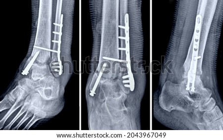 X- ray immobilization distal leg fracture Royalty-Free Stock Photo #2043967049