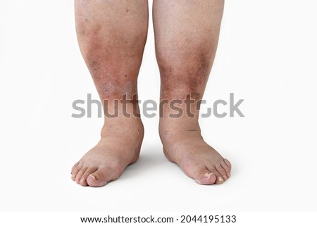 Swelling of the leg with inflammation in diabetic nephropathy in a woman, close-up. Royalty-Free Stock Photo #2044195133
