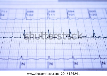 Electrocardiogram with cardiac arrhythmia. Atrial fibrillation recorded as the origin of many cerebrovascular accidents or strokes. Cardiovascular disease