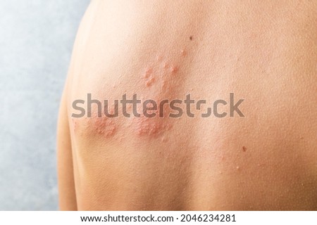 Skin infected Herpes zoster virus. Herpes Virus on body. urticaria rash. atopic dermatitis on body. Royalty-Free Stock Photo #2046234281