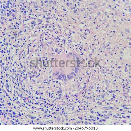 Camera photo of multinucleated giant histiocyte in lymph node of patient with tuberculosis, magnification 400x, photograph through a microscope Royalty-Free Stock Photo #2046796013