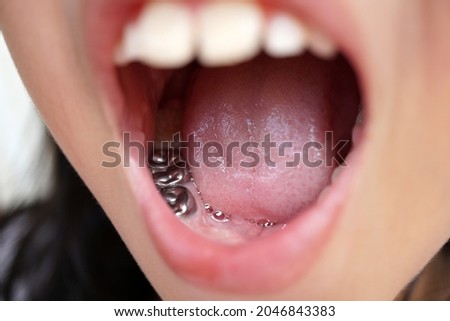 Selective focus for Tooth filling with composite resins called Amalgam Filling.  Royalty-Free Stock Photo #2046843383