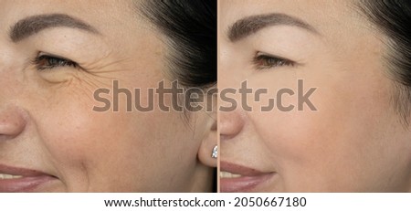 woman eyes wrinkles before and after treatment Royalty-Free Stock Photo #2050667180