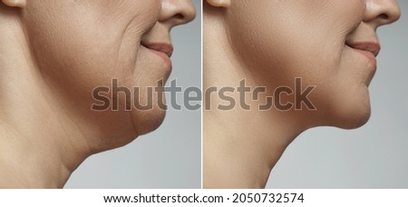 Difference after plastic surgery. Double chin removal, facelift and neck liposuction. Royalty-Free Stock Photo #2050732574