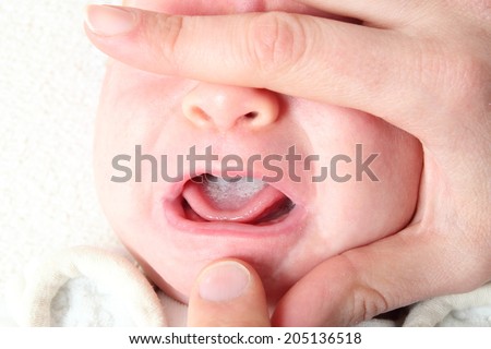 Oral thrush of a newborn baby Royalty-Free Stock Photo #205136518