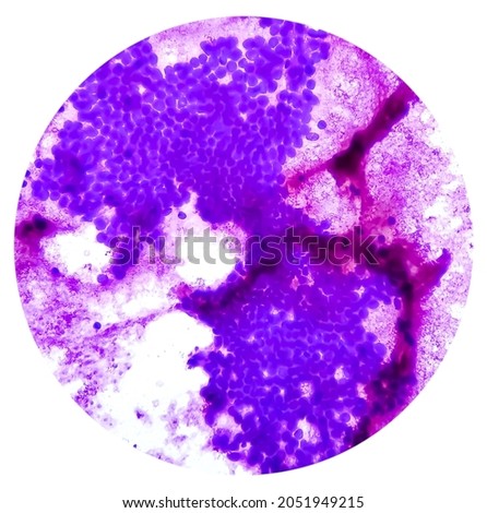 Hepatocellular dysplasia, cellular enlargement, nuclear pleomorphism, and multinucleation, light micrograph, photo under microscope Royalty-Free Stock Photo #2051949215