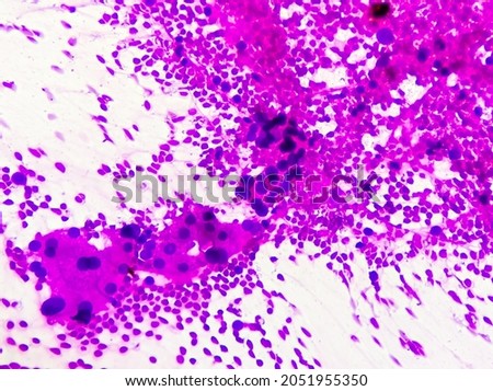 Hepatocellular dysplasia, cellular enlargement, nuclear pleomorphism, and multinucleation, light micrograph, photo under microscope 100x view Royalty-Free Stock Photo #2051955350