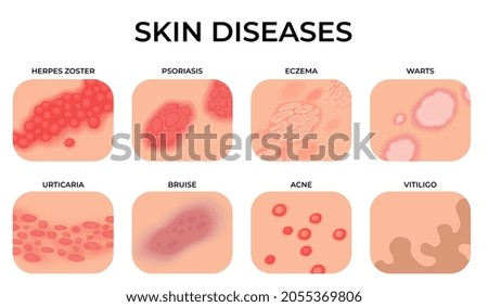 Skin disease. Different diseases, epidermis surface with eczema. Dermatology, allergy symptoms. Human body psoriasis, medical recent vector set Royalty-Free Stock Photo #2055369806