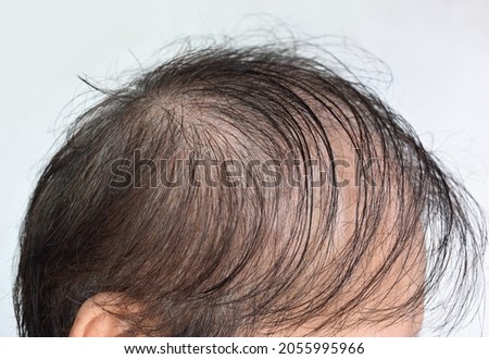 Thinning or sparse hair, male pattern hair loss in Southeast Asian, Chinese elder man. Royalty-Free Stock Photo #2055995966