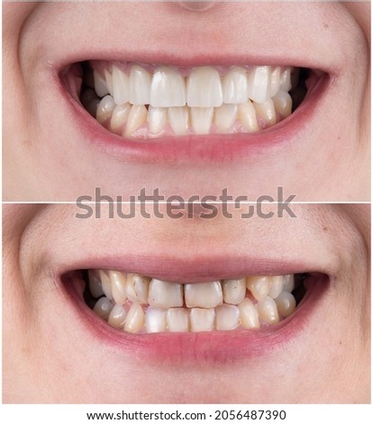 teeth treatment before and after picture 