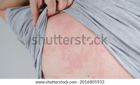 Close up image of skin texture suffering severe urticaria or hives or kaligata on the back. Allergy symptoms. Royalty-Free Stock Photo #2056805933