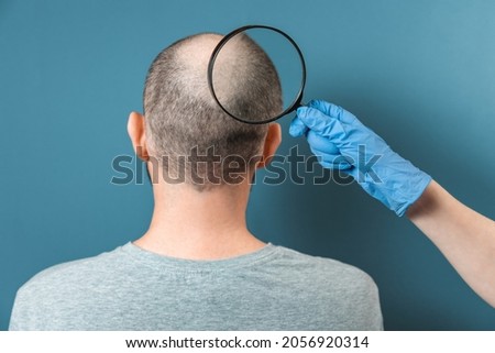A man with alopecia on his head is being examined by a trichologist. The doctor's hand holds a magnifying glass at the center of baldness. Back view.  The concept of baldness and alopecia. Royalty-Free Stock Photo #2056920314