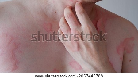 Man body suffering severe urticaria or hives or kaligata. Allergy symptoms. Royalty-Free Stock Photo #2057445788