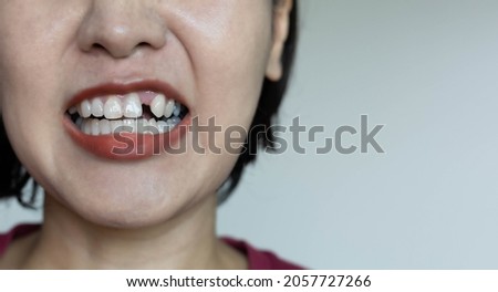 Woman's teeth, missing teeth, dental health can create uncertainty Royalty-Free Stock Photo #2057727266