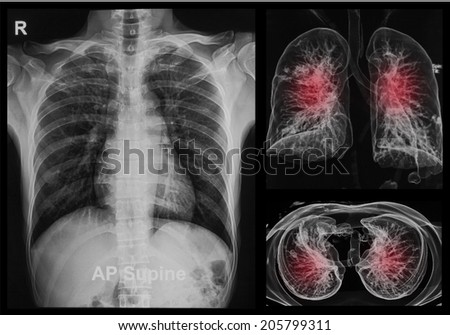 Chest X-rays under 3d image
