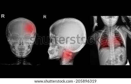 Collection of children x-rays  image show skull and chest image 