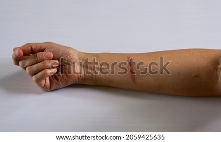 First degree burn on woman's arm  burning with heat  woman with burns on her arm  fire injuries  Lesions of iron burns on the skin of the forearm. Close-up wound from the iron on white background Royalty-Free Stock Photo #2059425635