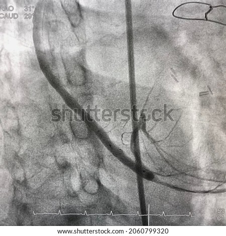 coronary angiogram showed saphenous vein graft (SVG) after Drug Eluting stent (DES) was deployed during percutaneous coronary intervention (PCI). Royalty-Free Stock Photo #2060799320