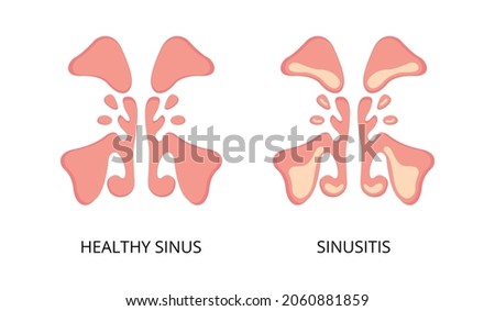 Healthy sinus and sinusitis flat image. Infection, inflammation, nasal diseases. Can be used for topics like health, diagnosis, anatomy Royalty-Free Stock Photo #2060881859
