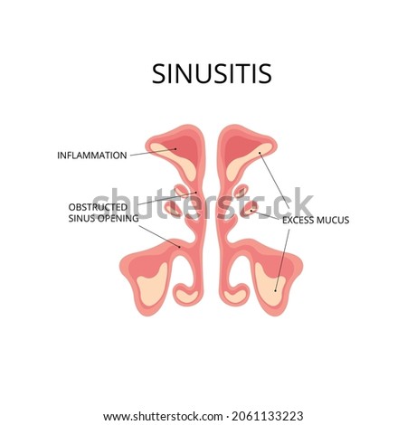Inflammated sinus with excess mucus and obstrusted sinus openings. Infection, nasal disease, anatomy. Can be used for topics like diagnosis, congestion, flu Royalty-Free Stock Photo #2061133223