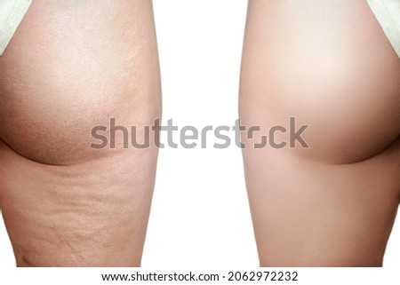 demonstration of Women's hip skin before and after therapy of stretch marks and cellulite removal procedure
