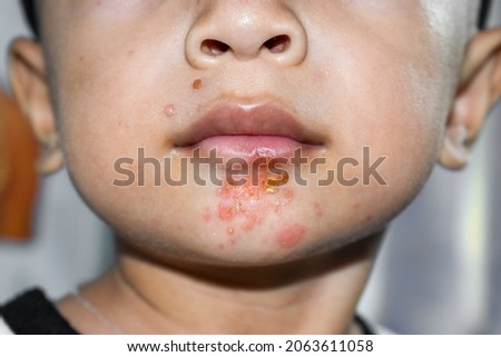 Staphylococcal skin infection called impetigo around mouth of Asian child Royalty-Free Stock Photo #2063611058
