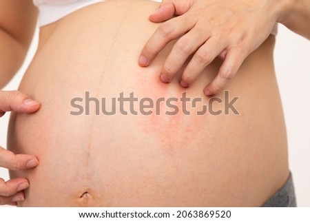 Close up Pregnant woman scratching her big belly itchy skin.Unrecognizable pregnancy woman having a skin problem on belly and scratching on itchy spot.Pregnancy Care Concept  Royalty-Free Stock Photo #2063869520