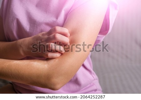 Young woman scratches her hands from itching. Allergic dermatitis. Skin disease vitiligo. Neurodermatitis disease, eczema or allergy rash. Healthcare and Medical Royalty-Free Stock Photo #2064252287