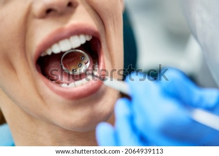 Close0up of woman having inner dental braces check-up at dentist's office. Royalty-Free Stock Photo #2064939113