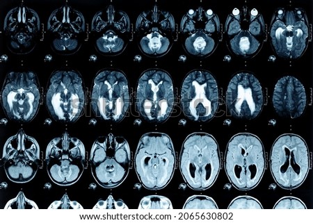 Real MRI scans of the head and brain. Magnetic resonance image scan of the brain showed obstructive triventricular hydrocephalus. Background on theme of science, medicine, neurology. Royalty-Free Stock Photo #2065630802