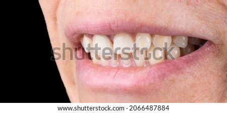 teeth with dameged gums and old crown to be replaced