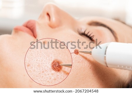 Electrocoagulation and laser cosmelotogy. Dermatologist using a professional electrocautery for removing mole. Zoomed area of melanoma. Royalty-Free Stock Photo #2067204548