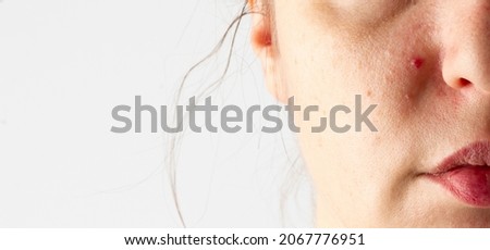 enlarged pores of the face, problem skin. Skin problem with acne diseases, Close up woman face. Beauty concept. woman face get sensitive skin. copy space Royalty-Free Stock Photo #2067776951